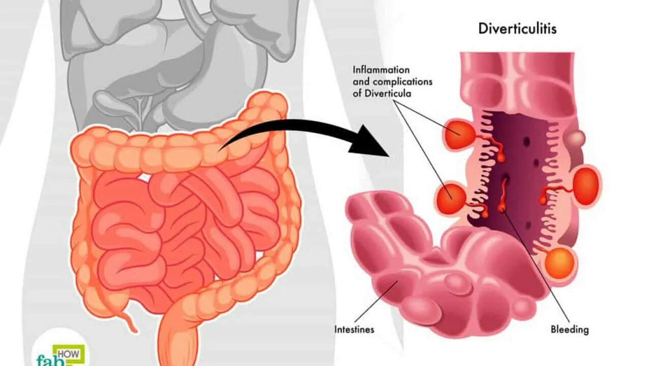 Почему крови кишечник. Дивертикулит кишечника.