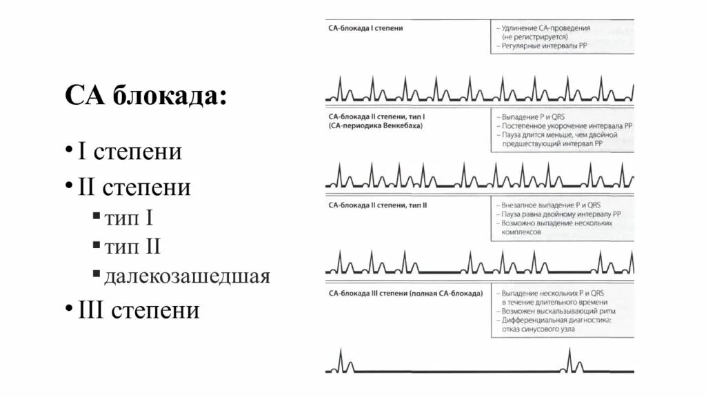 Блокады 2 степени армия. Далекозашедшая блокада 2 степени. Сердечные блокады. Аритмия блокада. Са блокада 2 степени 2 типа.