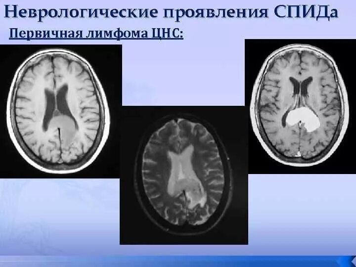 Лейкоэнцефалит