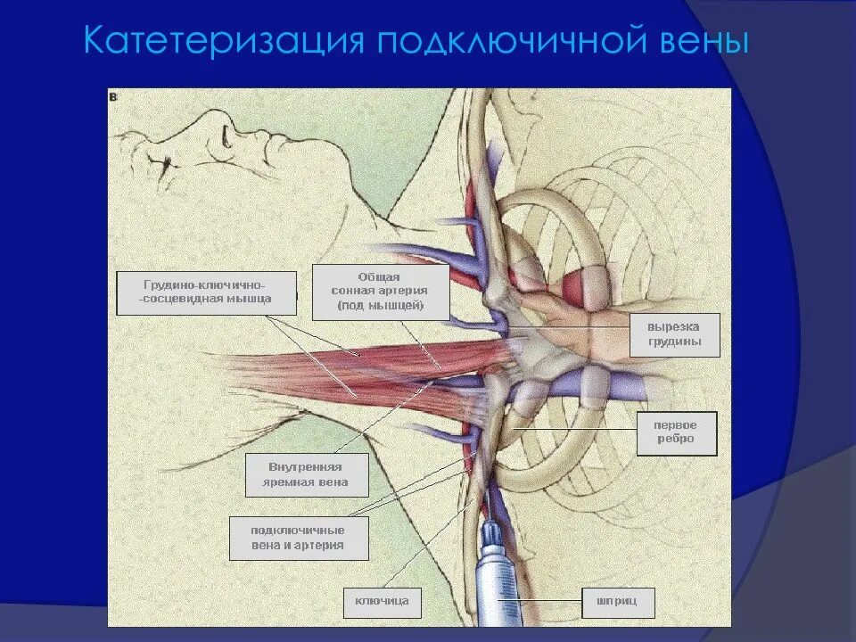 Правая подключичная вена. Подключичная Вена катетеризация. Техника постановки подключичного катетера. Техника катетеризации подключичной вены. Пункция подключичной вены алгоритм.