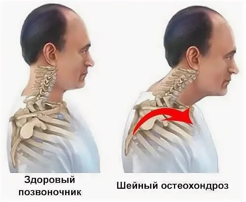 Болит шея остеохондроз. Шейный остеохондроз. Шея с увеличенной щитовидной железой. Шейный остеохондроз. Лекарства от остеохондроза шейного отдела позвоночника.