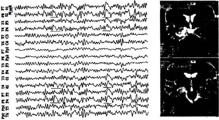 Пик медленная волна на ЭЭГ что это. Острая волна медленная волна на ЭЭГ. ЭЭГ эпилепсия пик-волна. Полипик волна на ЭЭГ. Медленные волны на ээг