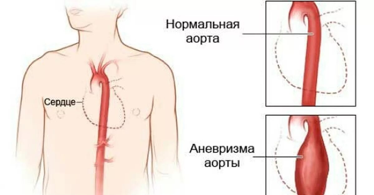 ЭКГ при аневризме аорты грудного отдела. Расслаивающаяся аневризма аорты ЭКГ. Расслаивающая аневризма ЭКГ. Атеросклероз грудного отдела аорты. Аневризма сердца что это такое симптомы