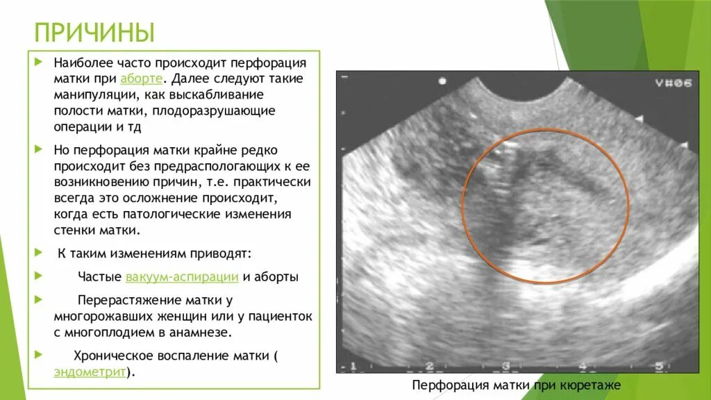 Выскабливание температура. Перфорация матки презентация. УЗИ признаки перфорации матки. Перфорация матки причины. Перфорация матки УЗИ картина.