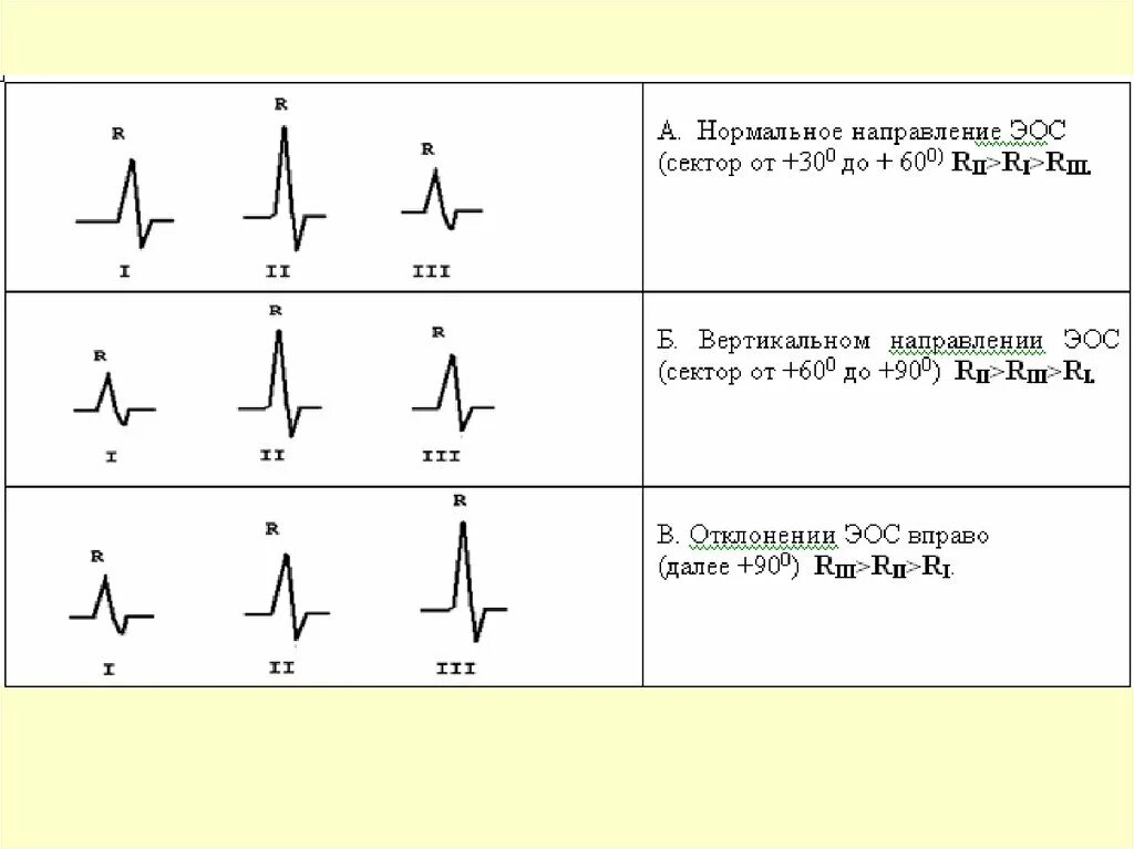 Вертикальная позиция сердца. Электрическая ось сердца на ЭКГ как определить. ЭКГ при изменении направления электрической оси сердца. Эл ось сердца норма ЭКГ. Отклонение электрической оси сердца на ЭКГ как определить.