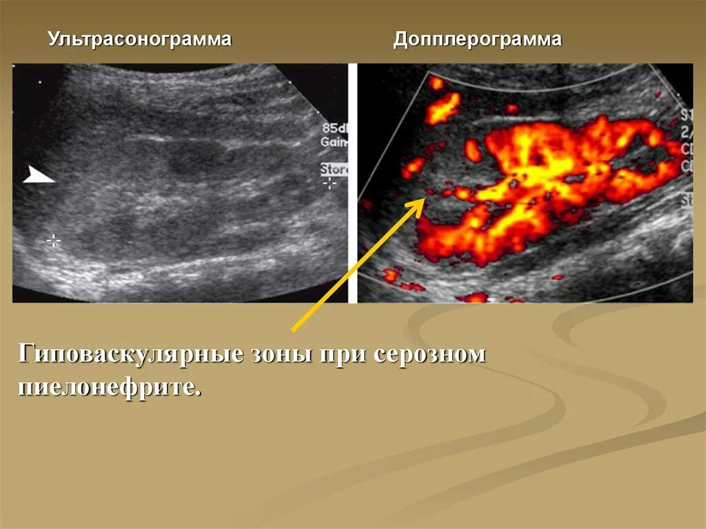 Гиповаскулярное образование в печени. Апостематозный пиелонефрит УЗИ картина. Хронический пиелонефрит УЗИ. Апостематозный нефрит УЗИ. УЗИ почек при остром пиелонефрите.