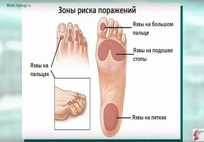 диабет пальцы. диабетическая нейропатия, диабетическая стопа. диабетическая стопа ампутация. диабетическая стопа фот. диабет пальцы.