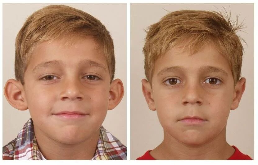 Уши выше глаз. Стрижки для лопоухих мальчиков. Лопоухость до и после операции.