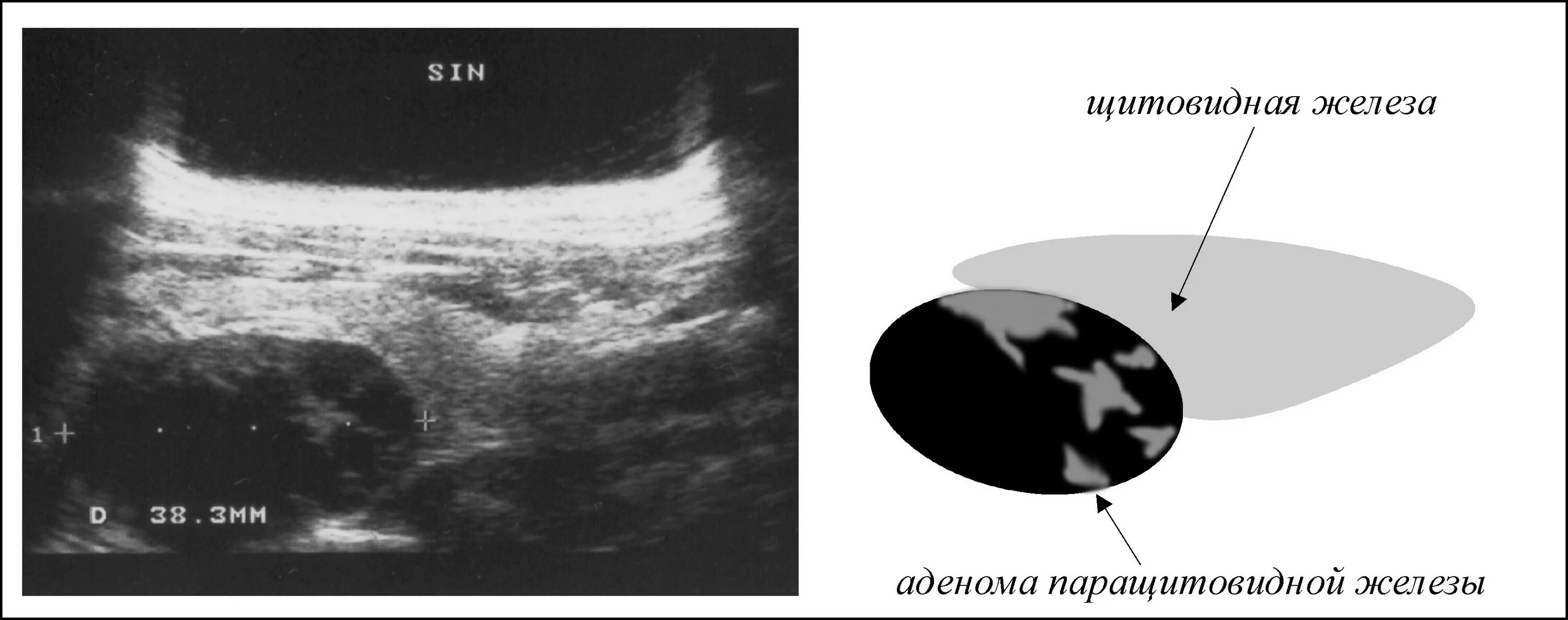 Гиперплазия щитовидной железы что это такое. Аденома паращитовидной железы на УЗИ. Аденома щитовидной железы на УЗИ. Аденома паращитовидных желез на УЗИ. Аденома околощитовидной железы на УЗИ.