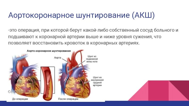 Аортокоронарное шунтирование операция. Аортокоронарное шунтирование (АКШ). Аорта коронарное шунтирование. Алрто коронарное шунтирование. Как делают коронарное шунтирование