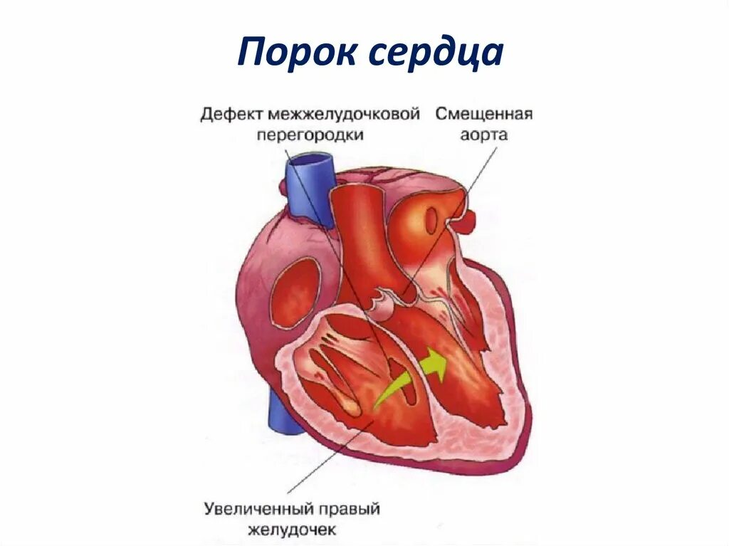 ВПС межжелудочковой перегородки. Врожденные и приобретенные пороки сердца. Межжелудочковая перегородка сердца. Порок сердца межжелудочковой перегородки.
