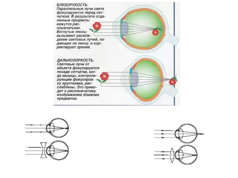 Лучи света фокусируются перед сетчаткой. При близорукости изображение фокусируется позади сетчатки. При близорукости лучи света фокусируются. При дальнозоргости световые лучи фокусируется?. Лучи света фокусируются за сетчаткой