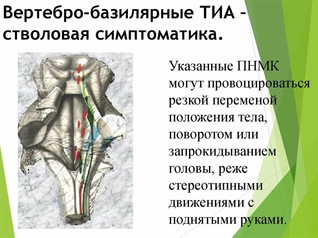 Вертебробазилярный синдром мкб