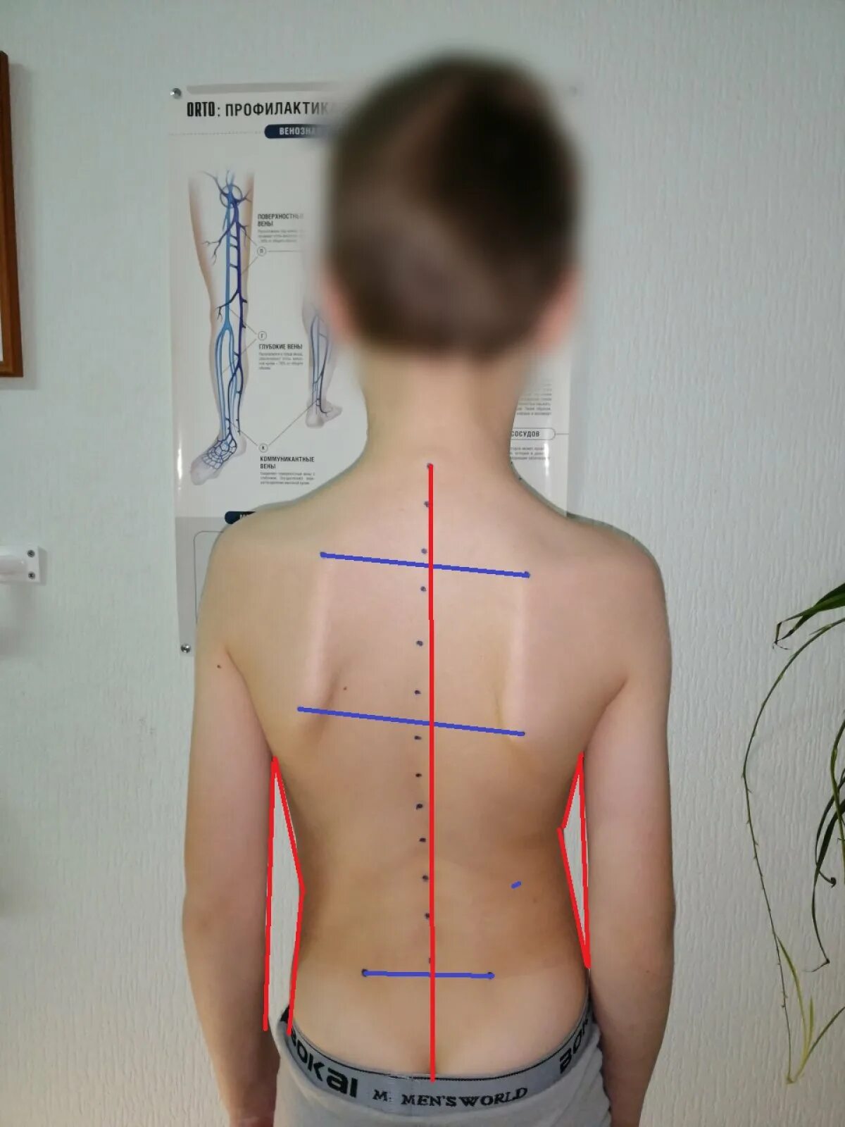 Child Deformities