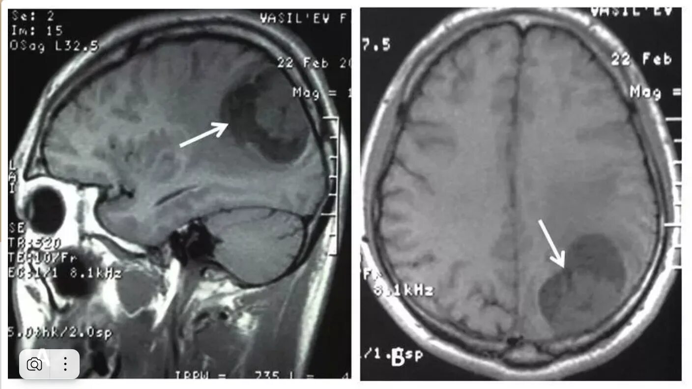 Менингиома головного мозга кт. Менингиома лобной доли мрт. Менингиома головного мозга мрт.