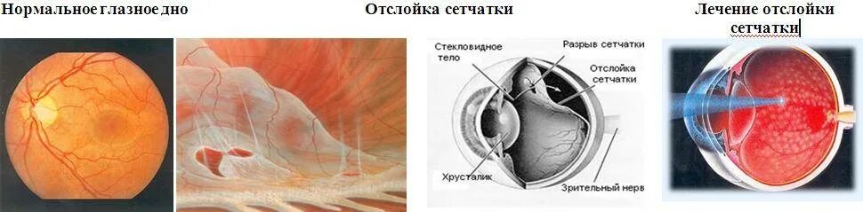 Пузыревидная отслойка сетчатки. Глазное дно отслоение сетчатки. Нерегматогенная отслойка сетчатки. Воронкообразная отслойка сетчатки.