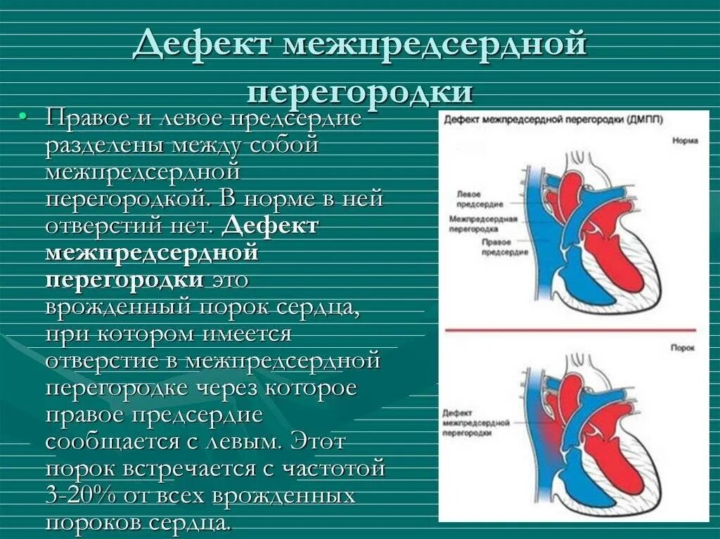 Аневризма перегородки у ребенка. Дефект межпредсердной перегородки патогенез. Врожденные пороки дефект межпредсердной перегородки. ВПС вторичный дефект межпредсердной перегородки.