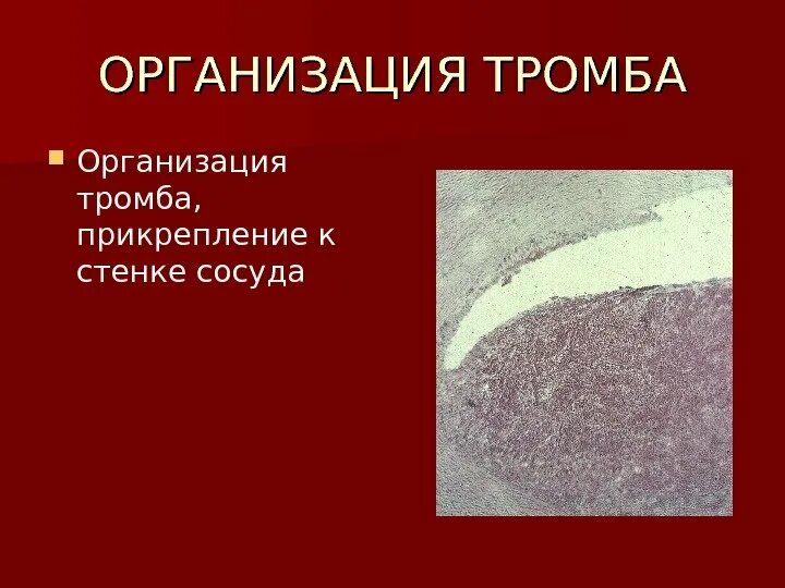 Описание тромба. Признаки организации тромба. Организационный тромб это. Организующийся тромб микропрепарат.