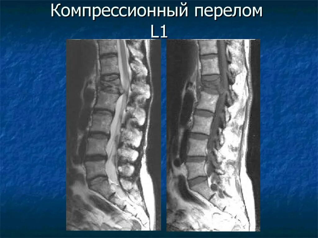 Перелом позвоночника у ребенка последствия. Компрессионный перелом позвонков l3 l4. Компрессионный перелом позвоночника th11-l1. Компрессионный перелом позвоночника th-5-6. Неосложненный компрессионный l1 перелом позвоночника.