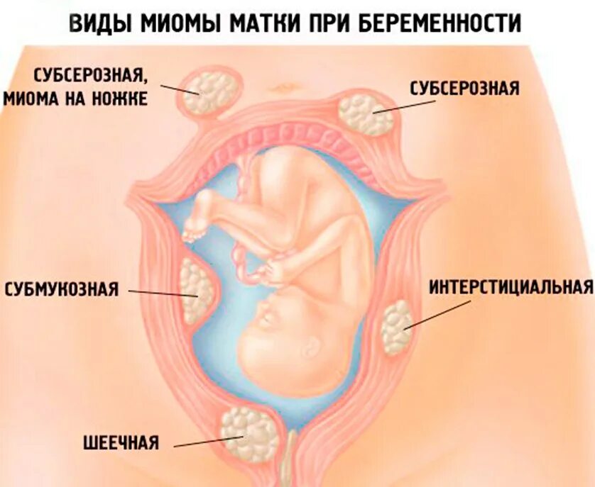 Можно ли беременность перепутать с миомой. Миома матки и беременность.