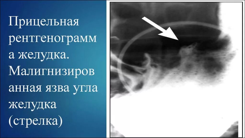 Малигнизированная язва желудка рентген. Прицельная рентгенограмма желудка. Малигнизация язвы рентген. Малигнизация желудка рентген.