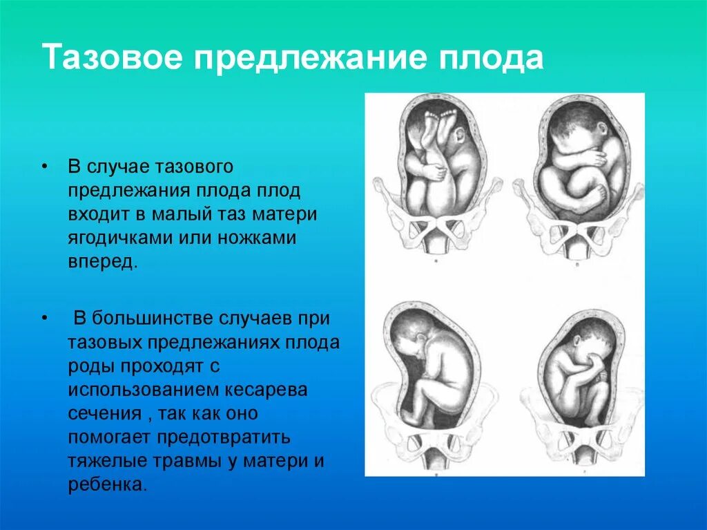 33 недели тазовое. Тазовое предлежание продольное головное. Положение продольное предлежание тазовое смешанное. Тазовое предлежание плода УЗИ. Тазовое ножное предлежание плода.