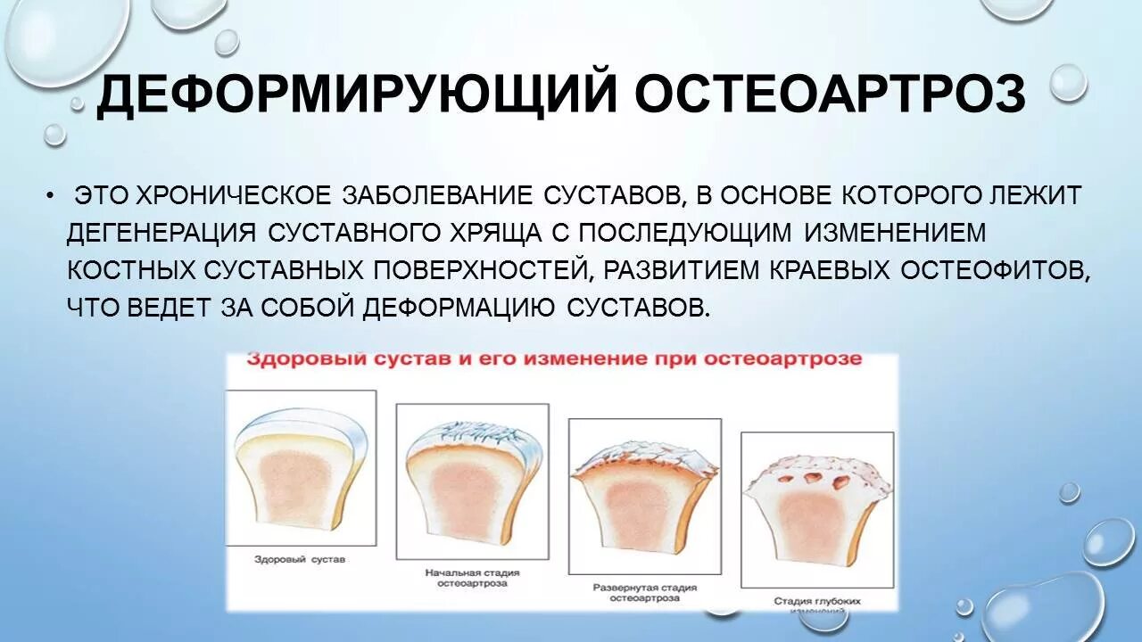 Деформирующий остеоартроз это