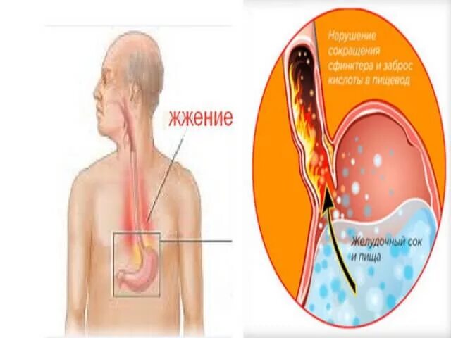 Изжога и жжение в пищеводе