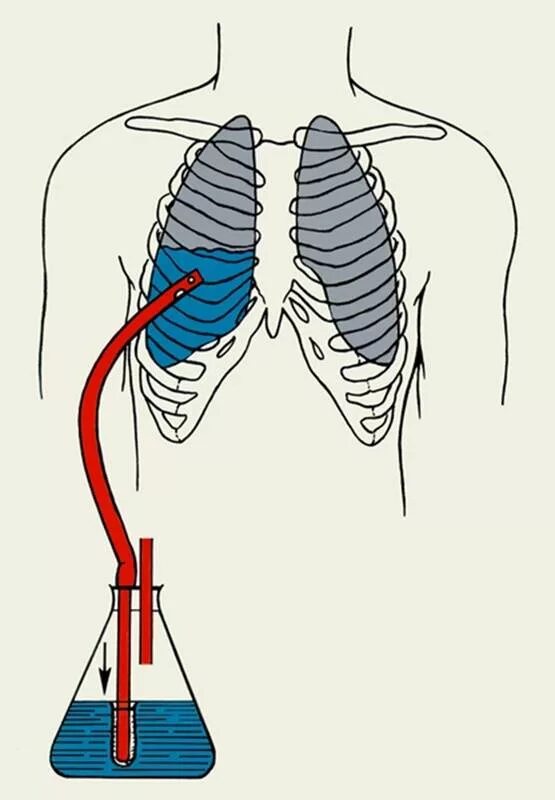 Пневмоторакс дренирование плевральной. Дренирование Бюлау техника плевральной полости. Дренаж в плевральную полость по Белау. Вода в легких название