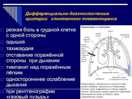 Дифференциальная диагностика пневмоторакса