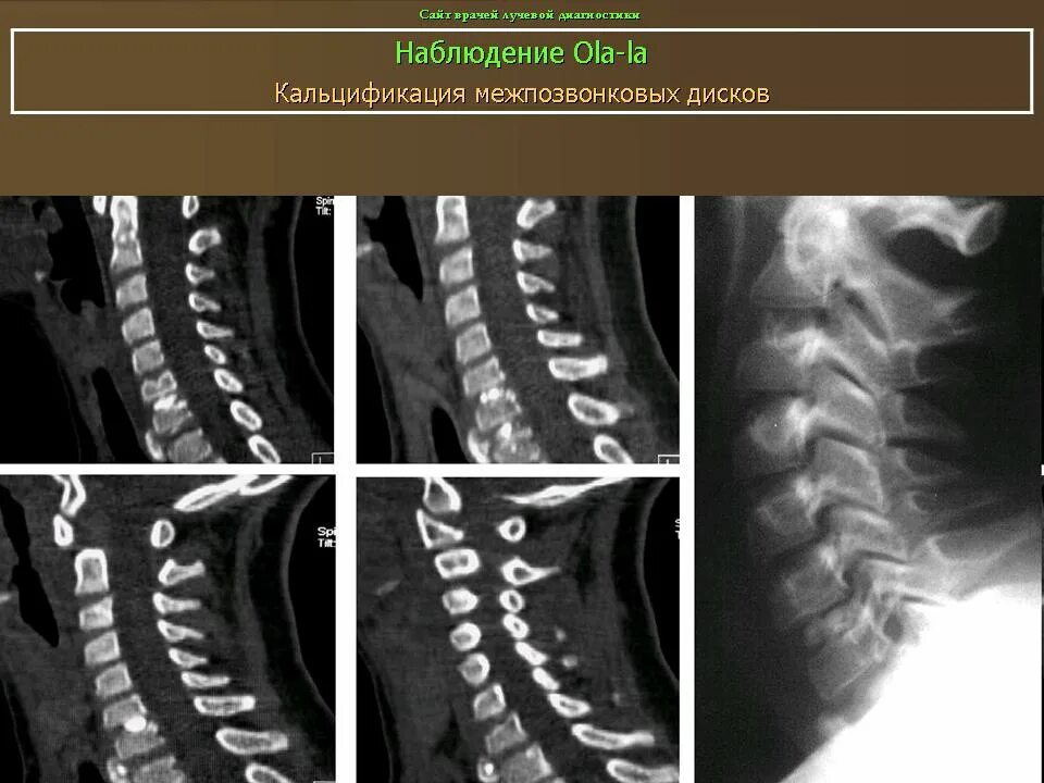 Дегенерация дисков