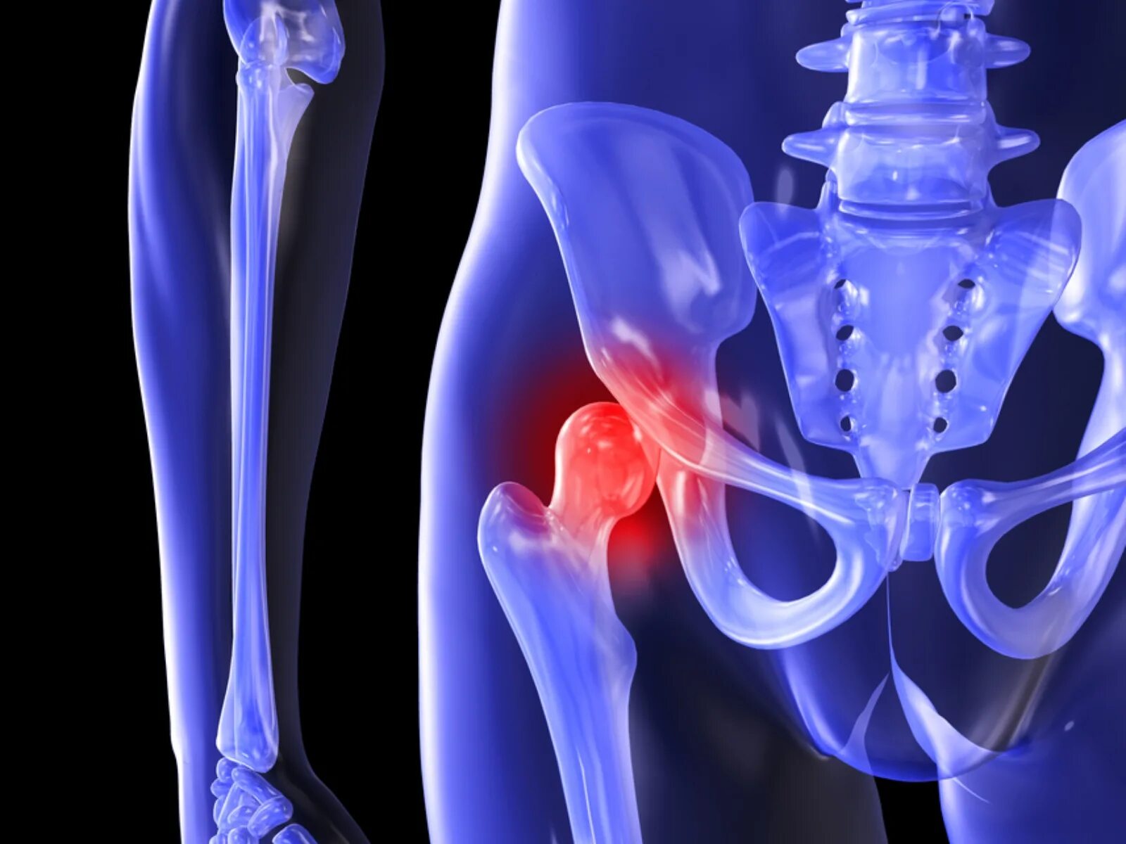 седалищный нерв в области бедра. боль в области головки бедренной кости.
