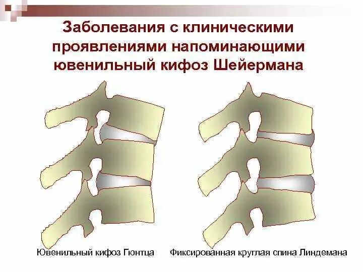 Дегенерация межпозвонкового диска по pfirrmann