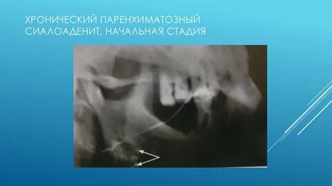 Интерстициальный сиалоаденит