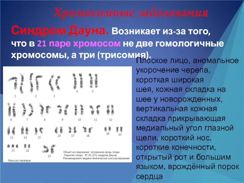 Синдром Дауна (трисомия по 21 паре хромосом). Болезнь Дауна набор хромосом. Синдром Дауна трисомия 21 хромосомы. 21 Пара хромосом трисомия. Наличие лишней хромосомы