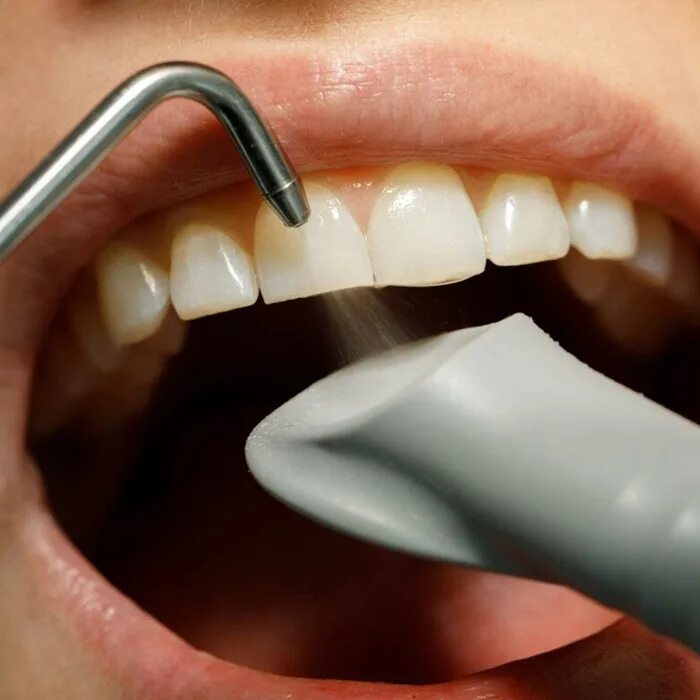 профессиональная гигиена полости. профгигиена полости рта air flow. профгигиена полости рта air flow. полости рта профгигиена полости рта. чистка зубок.