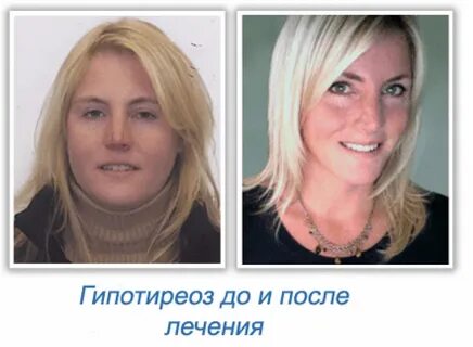 Гипотериоз после лечения