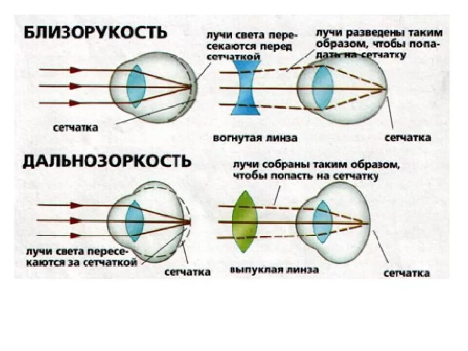 Будет видеть как правильно. Строение глаза человека близорукость и дальнозоркость. Близорукость и дальнозоркость линзы. Дальнозоркость и близорукость строение глаза. Линзы для близорукости и дальнозоркости физика.