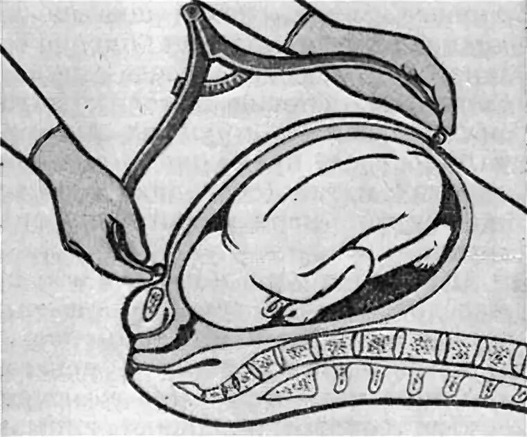 Приемы леопольда алгоритм. Измерение длины плода тазомером. Измерение ОВОИДА И головки плода. Измерение длины ОВОИДА плода.