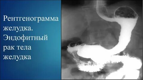 Эндофитная опухоль