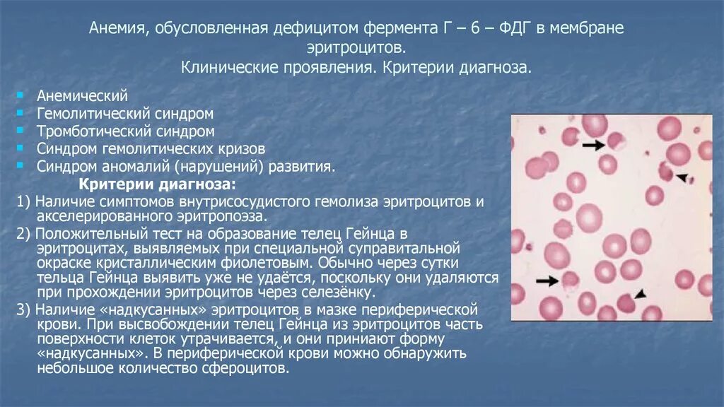 Анемия и эритроциты в крови. Ферментопатии гемолитическая анемия. Гемолитическая анемия дефицит глюкозо 6 фосфатдегидрогеназы. Картина периферической крови при гемолитической анемии. > Дефицит г-6-ФДГ В эритроцитах.