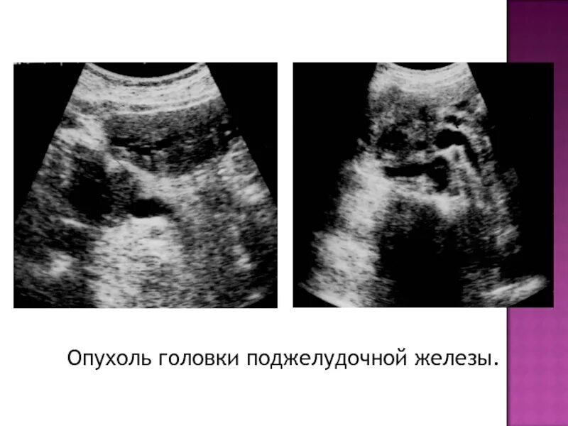 Абсцесс поджелудочной железы УЗИ. Головка поджелудочной железы. Головка поджелудочной железы на УЗИ. Утолщение на головке поджелудочной железы. Рак головки члена