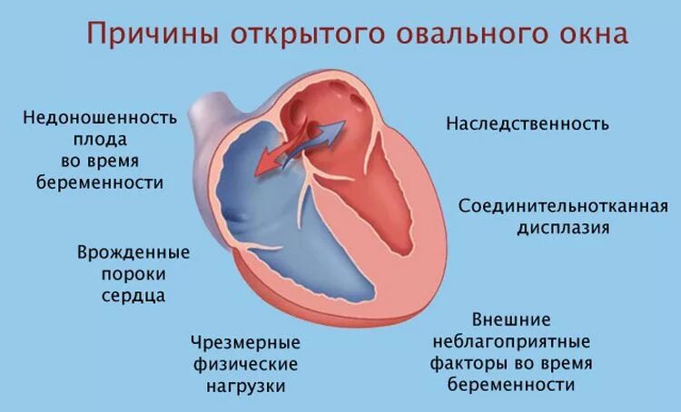 Окно в сердце у новорожденного. Овальное окно в сердце новорожденных располагается. функционирующее открытое овальное окно у новорожденных. открытое овальное окно у новорожденного 2 мм. открытое овальное окно межпредсердной перегородки.