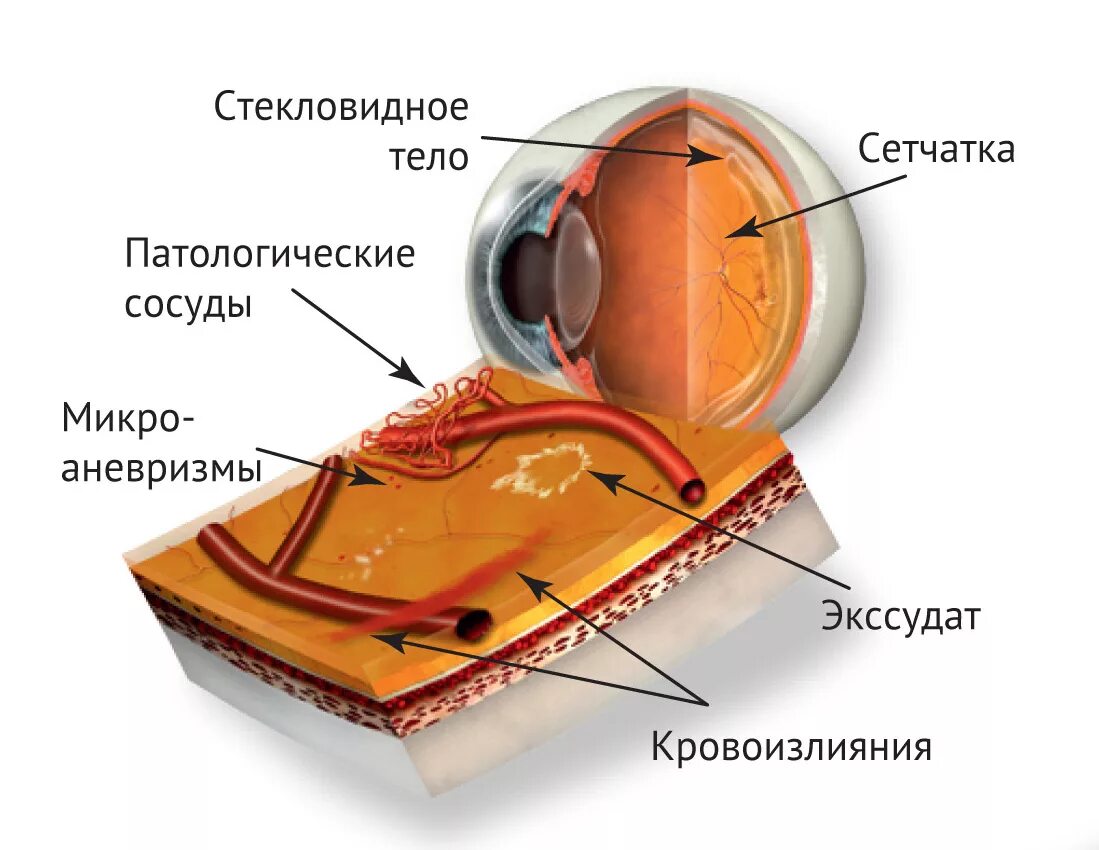 Диабетическая ретинопатия лазерная коагуляция. Диабетическая ретинопатия сетчатки. Лазерная коагуляция сетчатки при ретинопатии. Лазеркоагуляция сетчатки глаза.