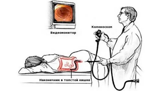 Скопия кишечника