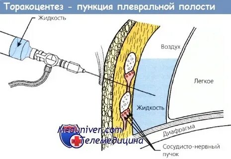 Жидкость в легких операция