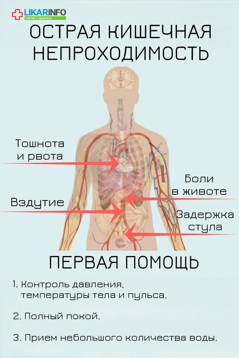 Симптомы непроходимости кишечника у взрослых. Острая кишечная непроходимость симптомы. признаки острой кишечной непроходимости. кишечная непроходимость симптомы. симптомы при острой кишечной непроходимости.