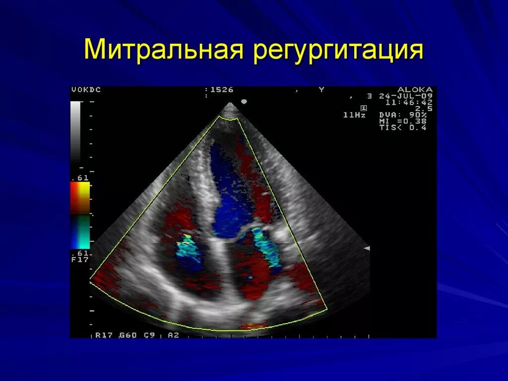 Тк регургитация 1. ЭХОКГ митральная регургитация 1 степени. Митральная регургитация ЭХОКГ. УЗИ сердца митральная недостаточность. Дилатация левого предсердия митрального клапана 1с.