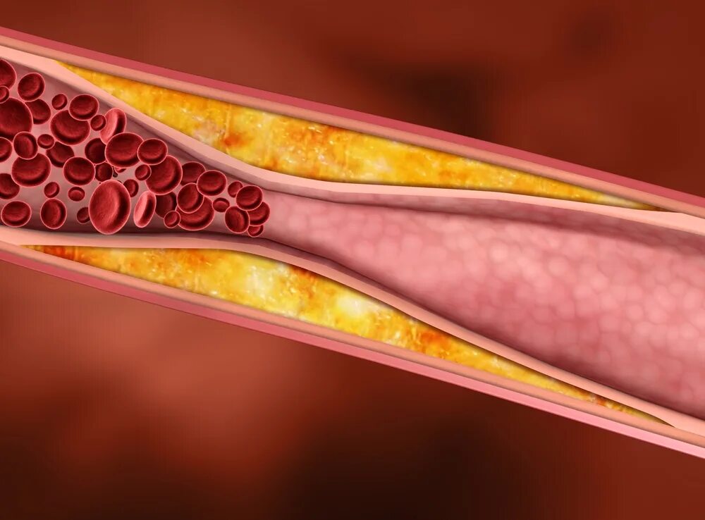 Атеросклеротическая бляшка фото. Холестериновые бляшки в сосудах. Закупорка кровеносных сосудов.