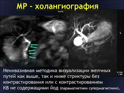 Мрт протоков